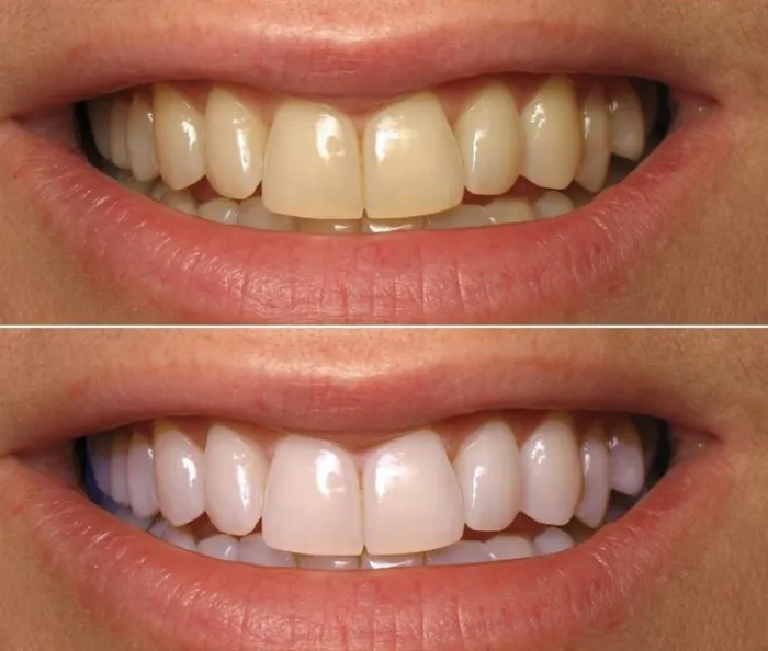 29622 whitening strips application