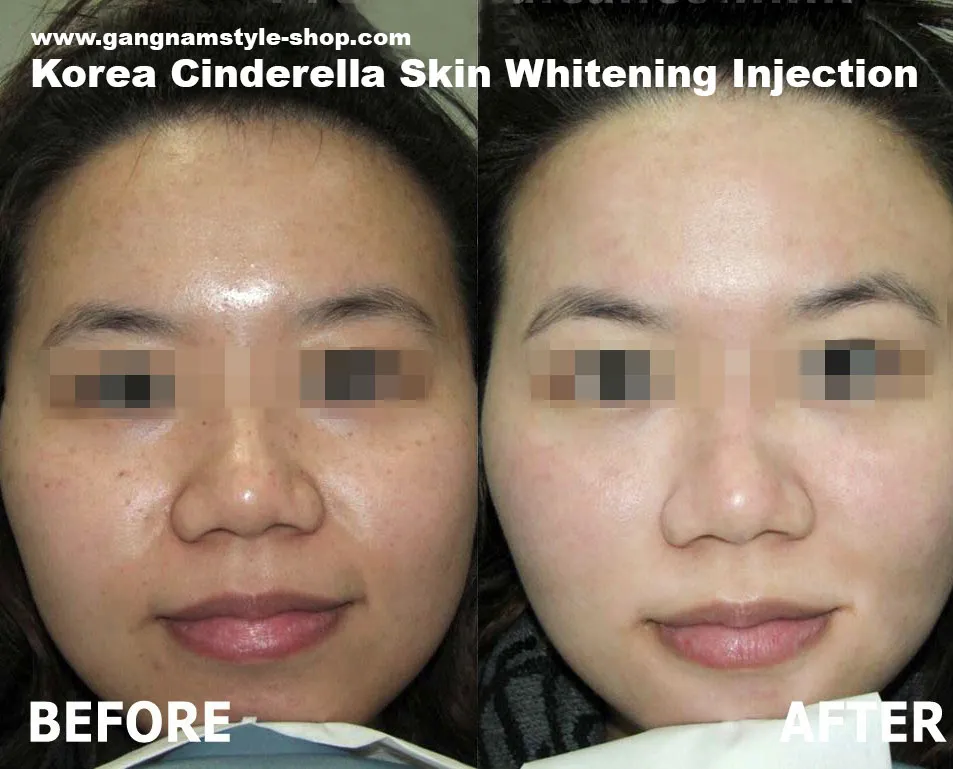 29625 skin whitening surgery procedure