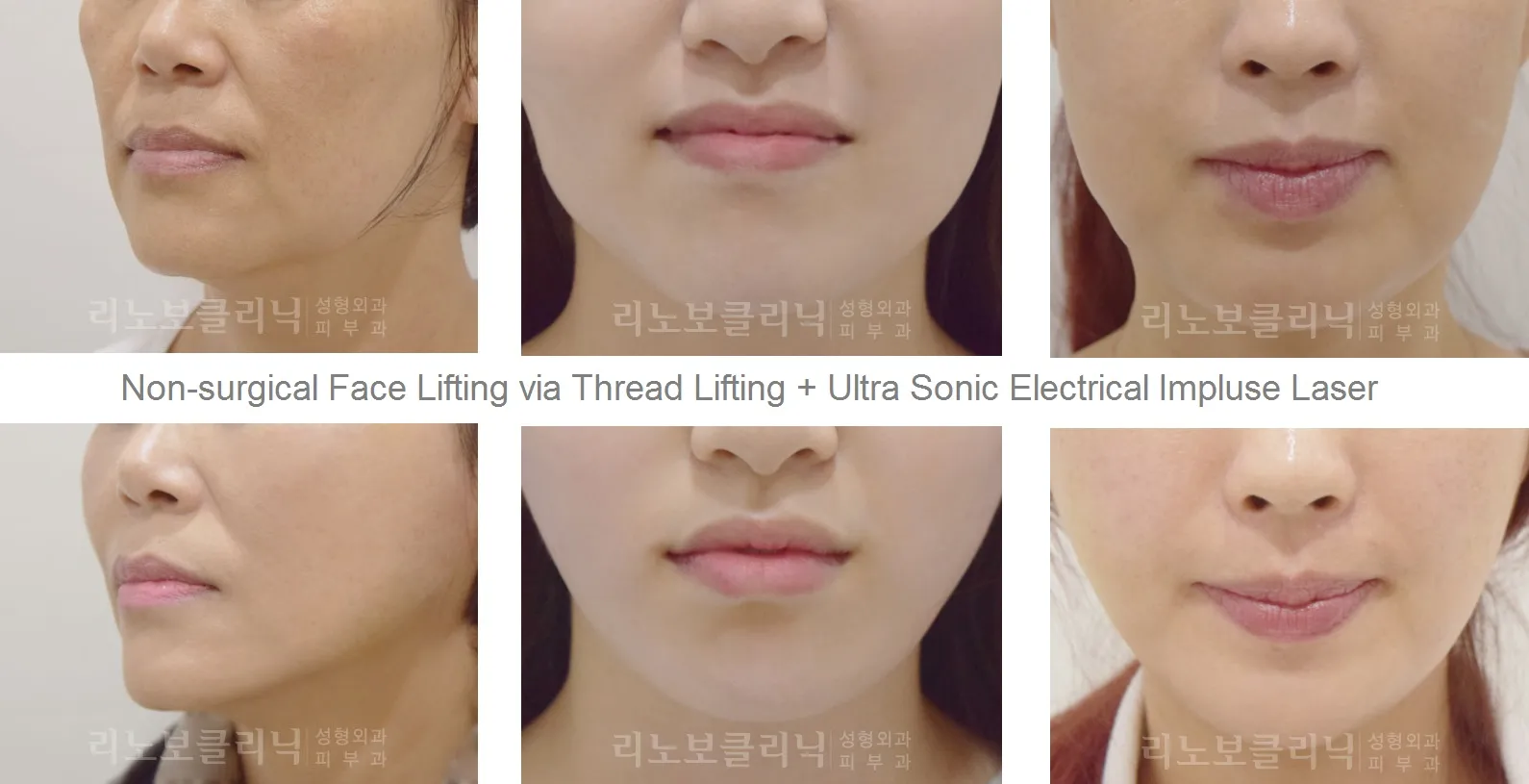 29625 skin whitening surgery recovery