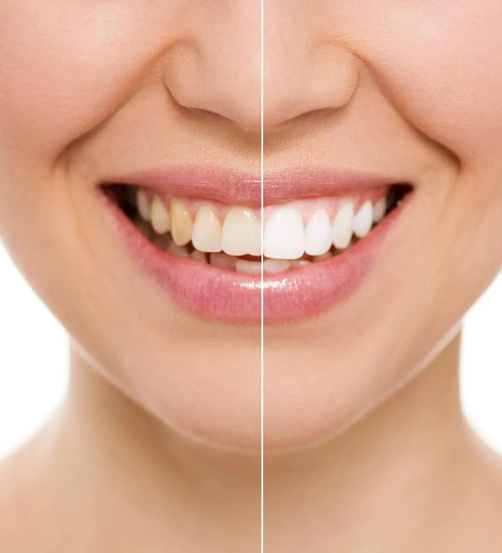 29629 teeth whitening colorado springs 2