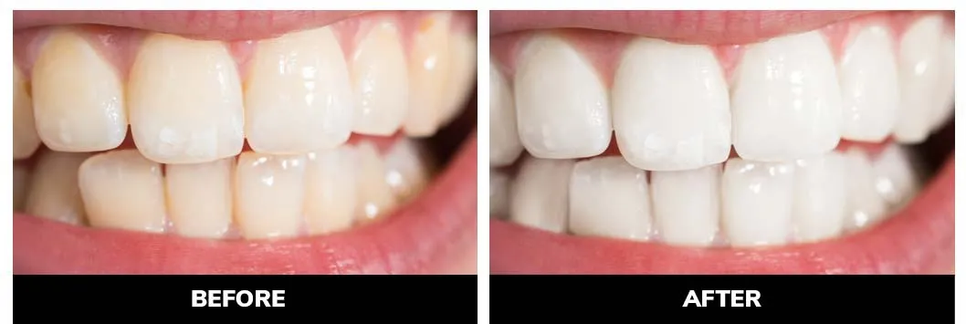 29629 teeth whitening colorado springs 4