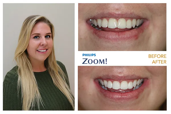 29633 zoom whitening cost