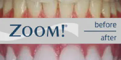 /img/29633-zoom-whitening-patient.webp