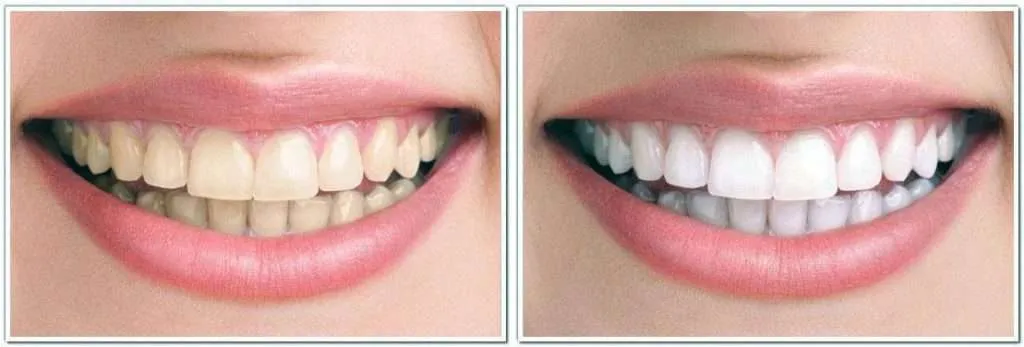 29633 zoom whitening results 2