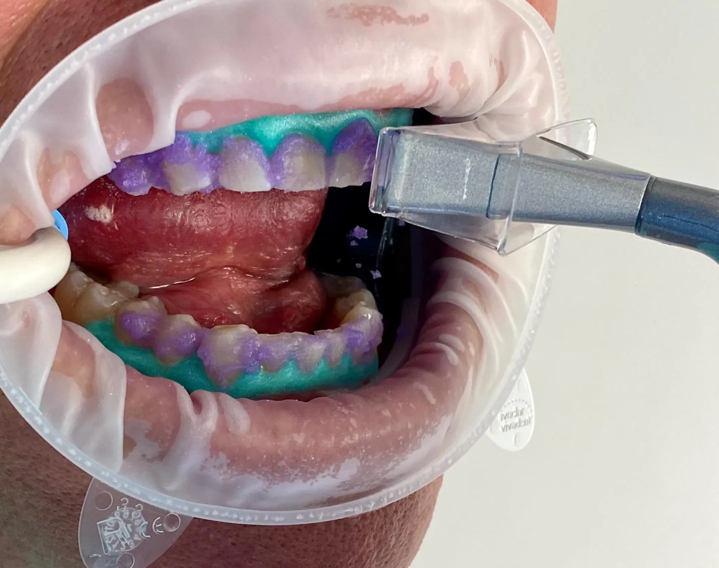 29635 teeth laser whitening