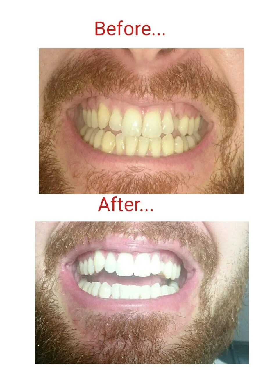 29636 laser teeth whitening process