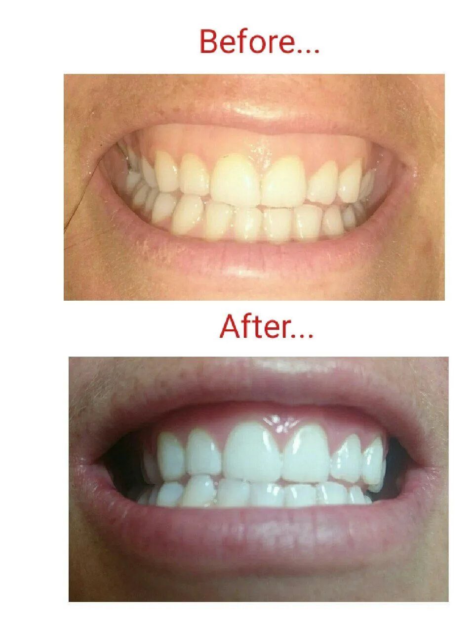 29636 teeth whitening before after