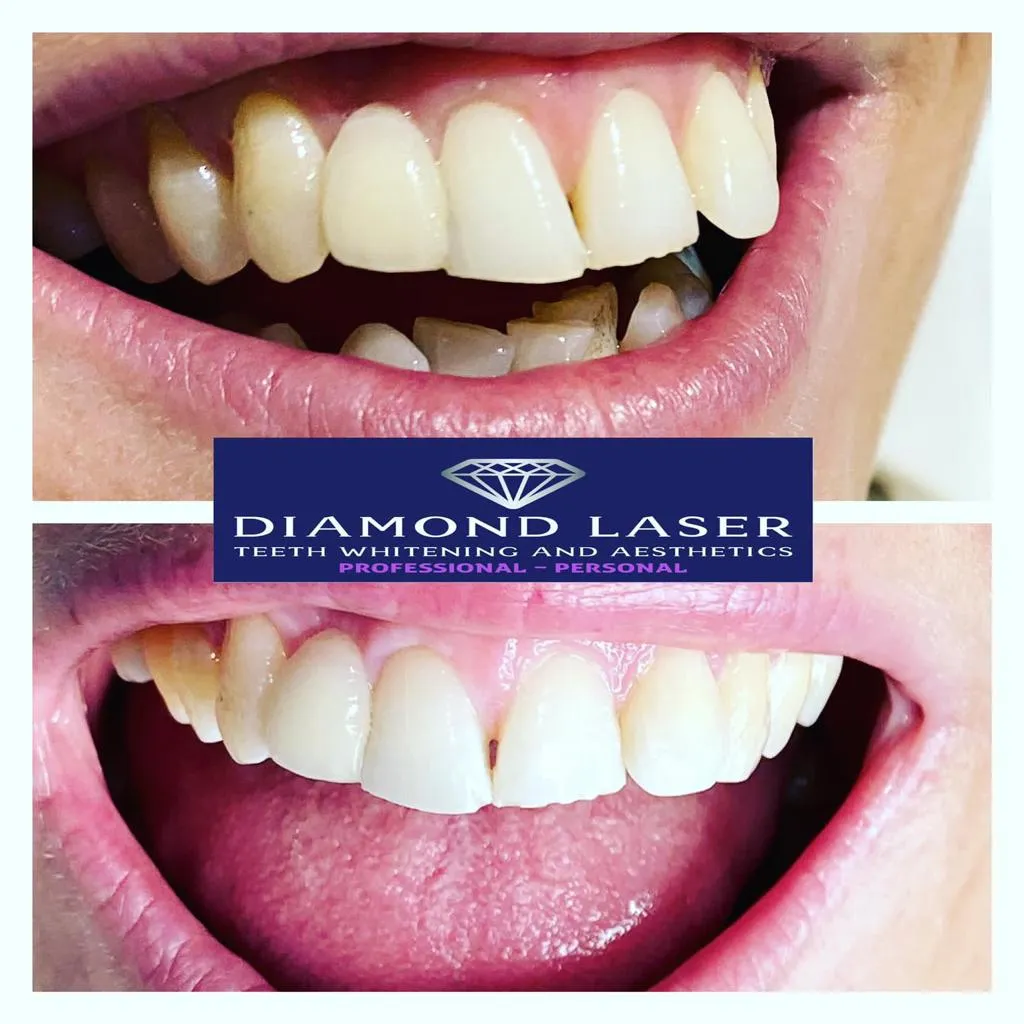 29636 teeth whitening side effects