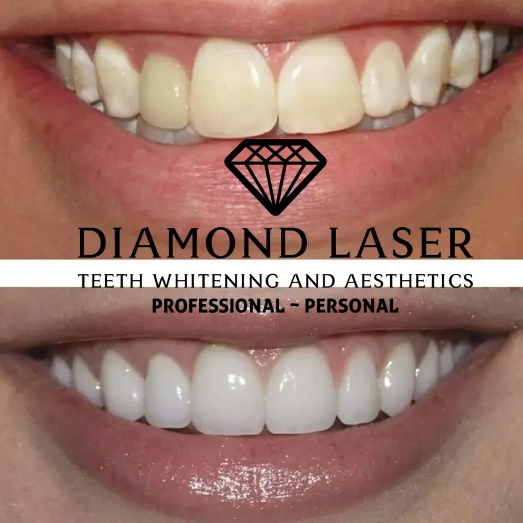 29636 teeth whitening smile