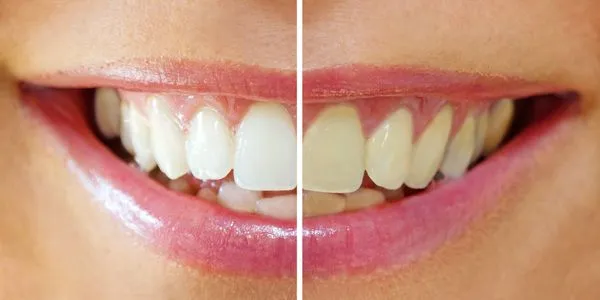 29639 professional teeth whitening