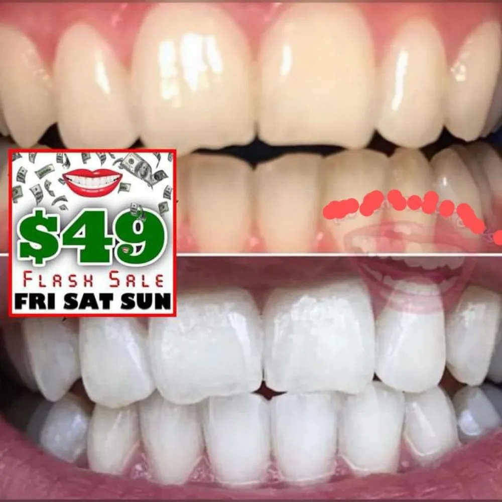 29639 teeth whitening cost