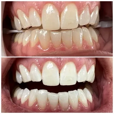29639 teeth whitening maintenance