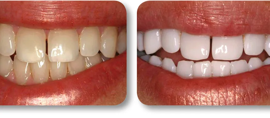 29640 enamel damage