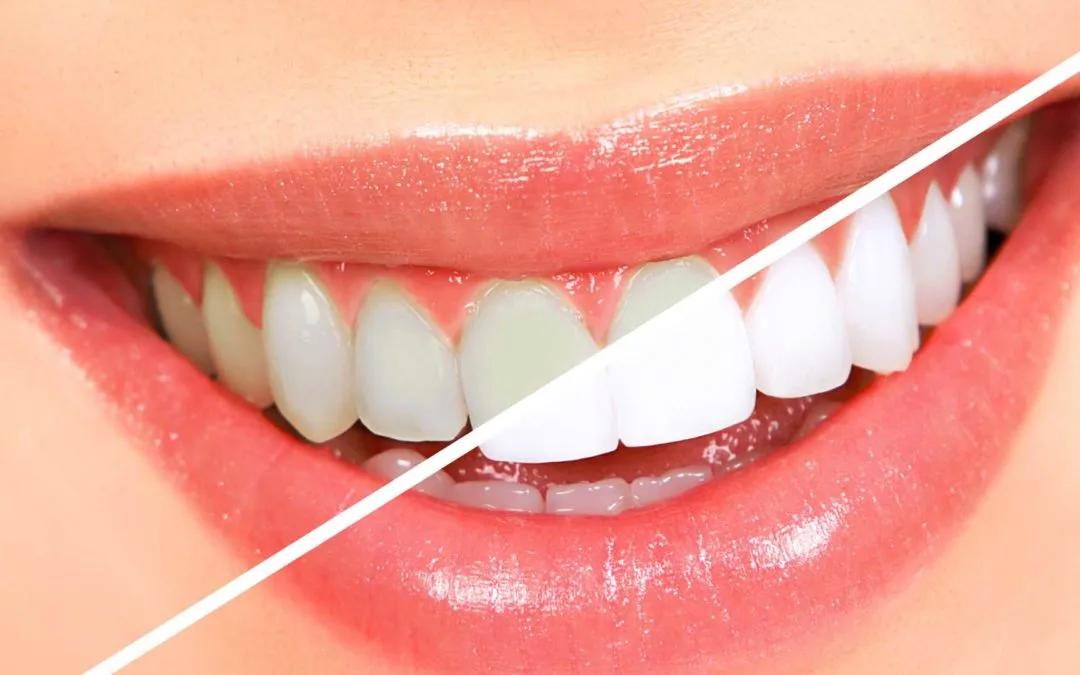 /img/29640-teeth-whitening-alternatives.webp