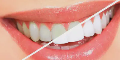 /img/29640-teeth-whitening-alternatives.webp