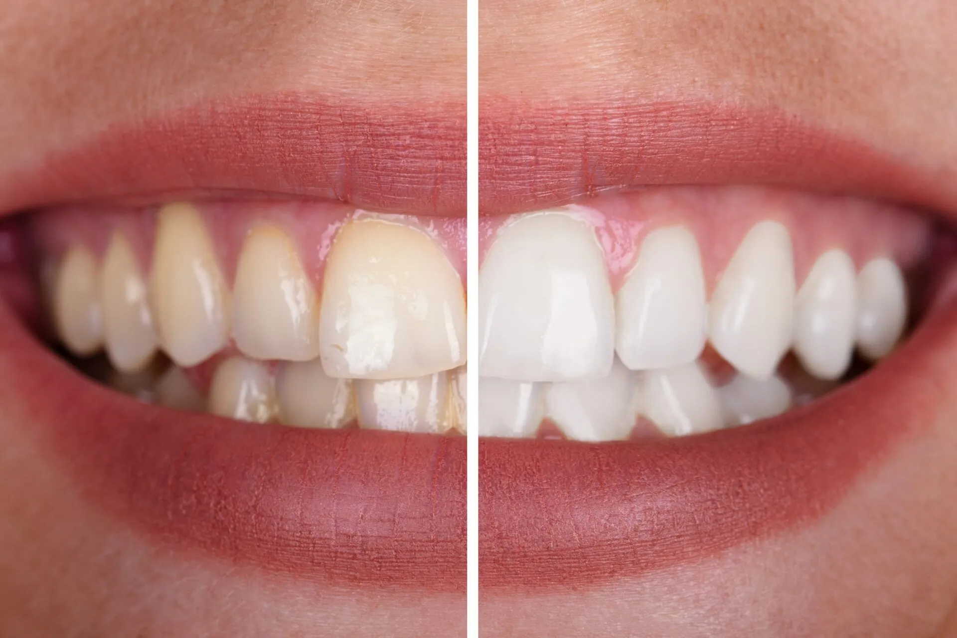 29640 uneven whitening