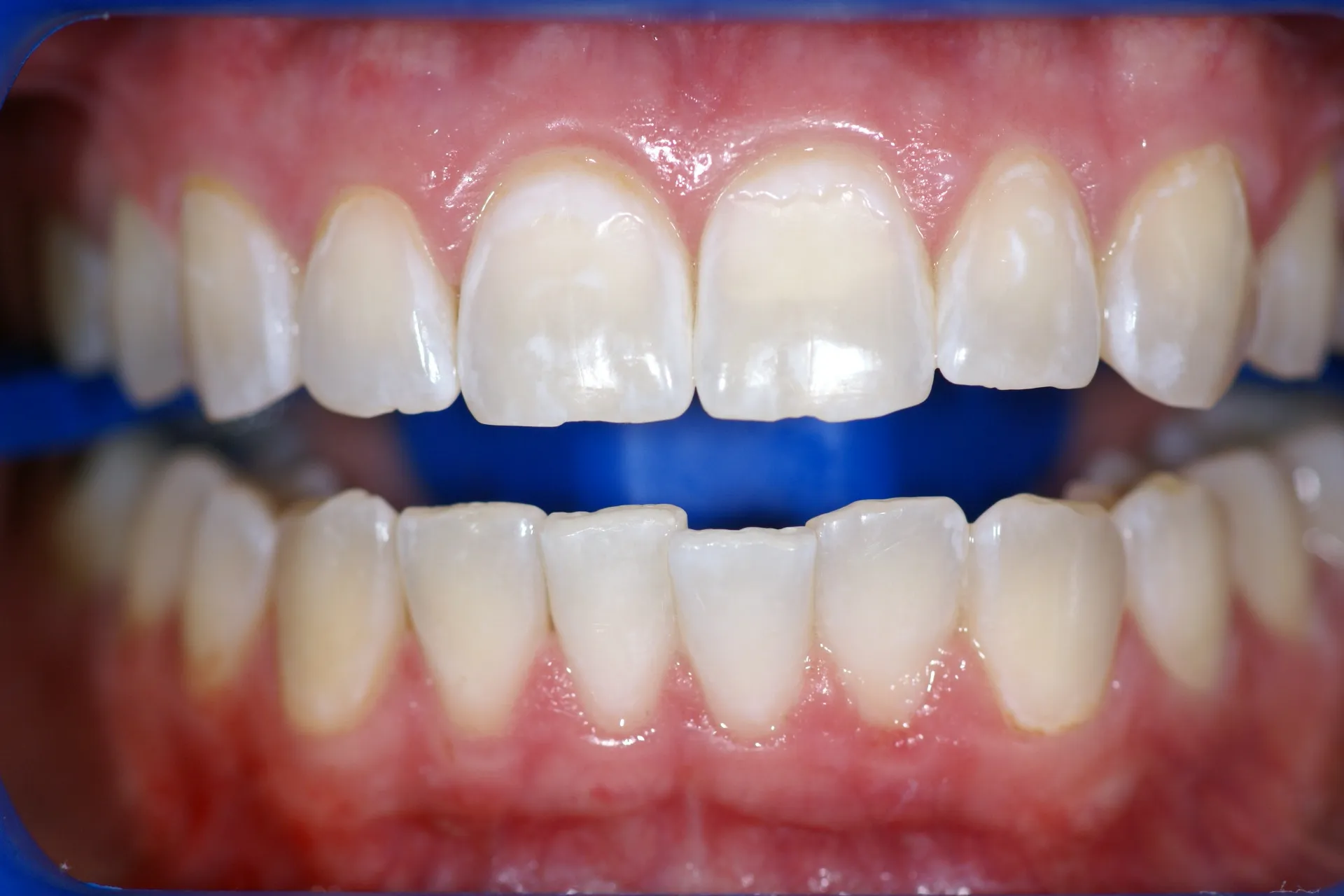29643 zoom whitening before after