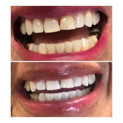 29644 at home teeth whitening kits