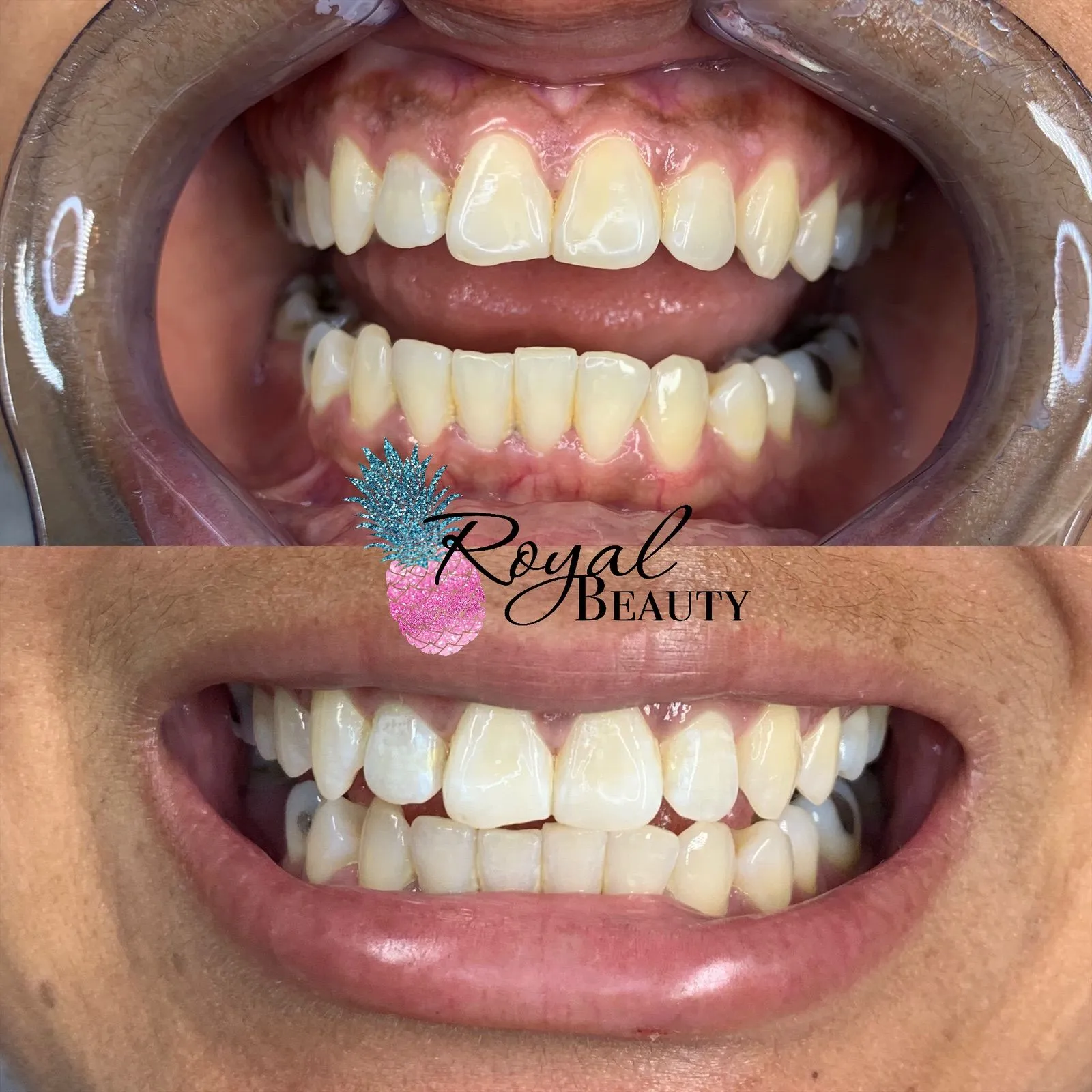 29644 in office teeth whitening