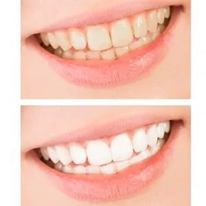 29647 cleveland teeth whitening at home kit