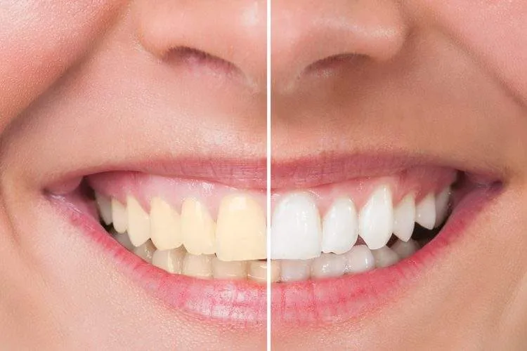 29647 cleveland teeth whitening maintenance