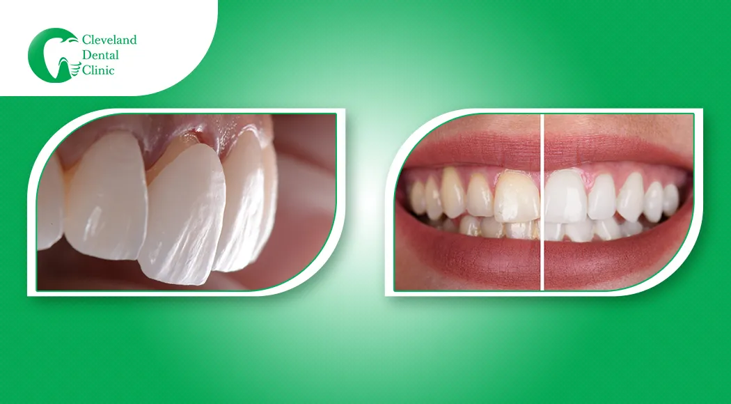 29647 cleveland teeth whitening procedure